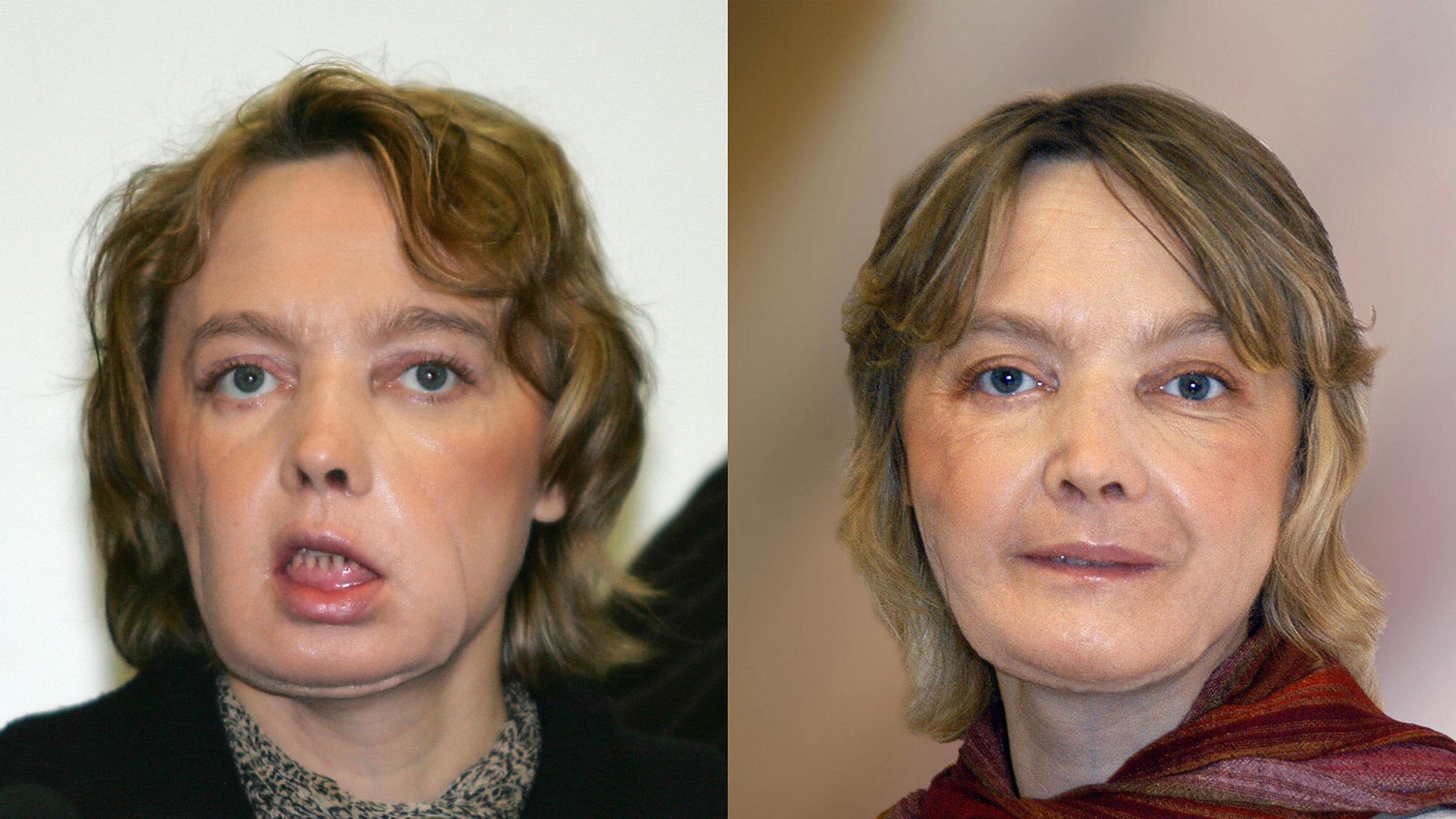 Facial first picture transplant