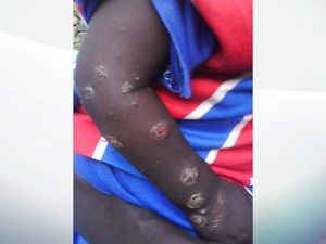 Sudan used chemical weapons in Darfur attacks, claims Amnesty Sudan used chemical weapons in Darfur attacks, claims Amnesty