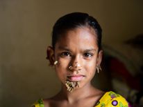 10-year-old Bangladeshi girl Sahana Khatun, could be the first female ever afflicted by so-called 'tree man syndrome'