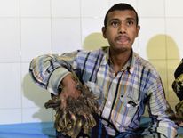 So-called 'Tree Man' Abul Bajandar, from Bangladesh, with his daughter , after surgery to remove massive warts on his body