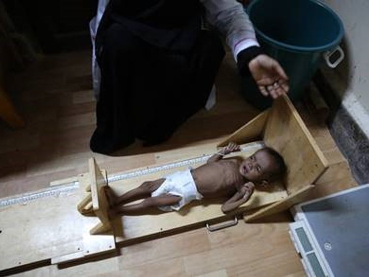 Millions of children are at greater risk from cholera due to malnutrition