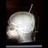 '1mm from death': Boy's skull pierced with screw