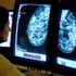 The study is thought to be the largest breast cancer treatment trial ever