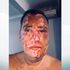 A man disfigured by an unprovoked acid attack has made a fresh appeal to find the man responsible almost six months after the assault.
