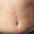 Measles warning to holidaymakers as European cases soar