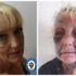 Lynn Hart suffered horrific injuries at the hands of her partner. Pic: West Midlands Police
