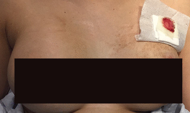 Woman saved after breast implant deflected bullet away from her ...
