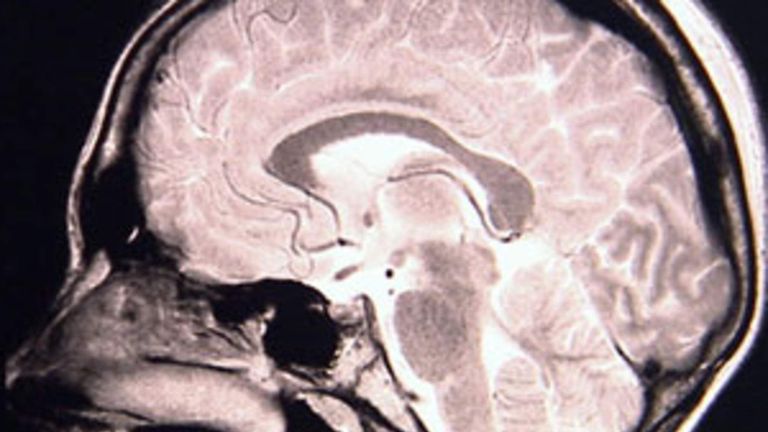 Doctors study a brain scan of someone with epilepsy