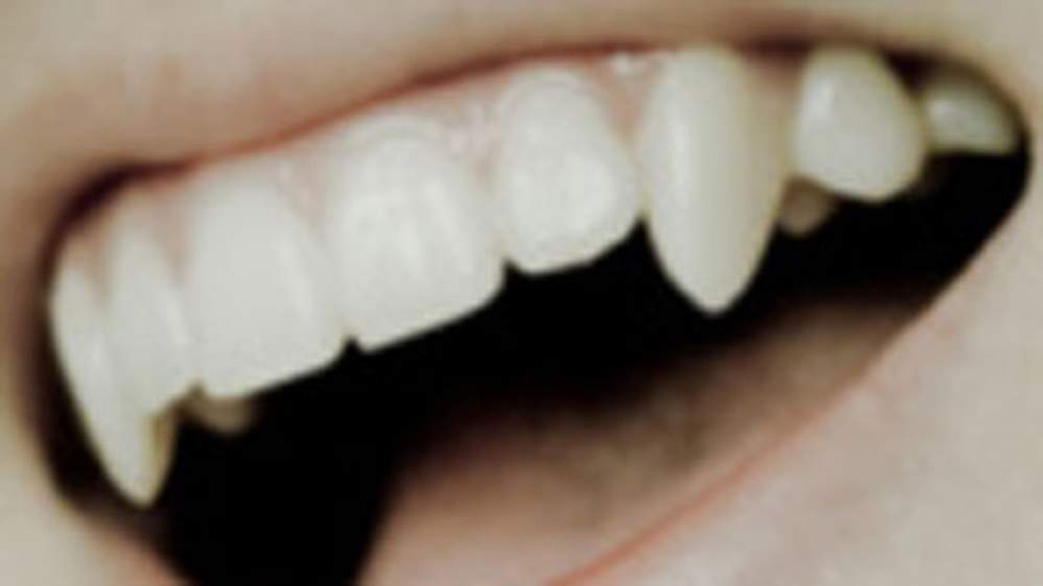 Клык фото зуба. Острые зубы у человека Эстетика.