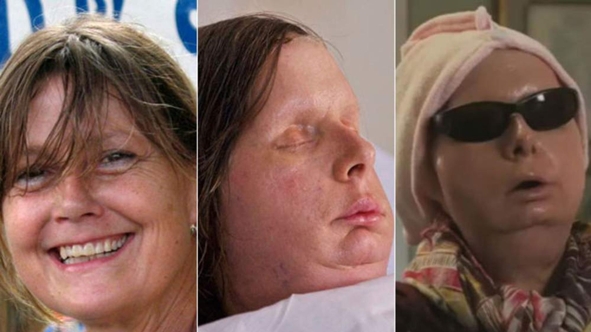 Chimp Attack Face Transplant Woman Speaks World News Sky News