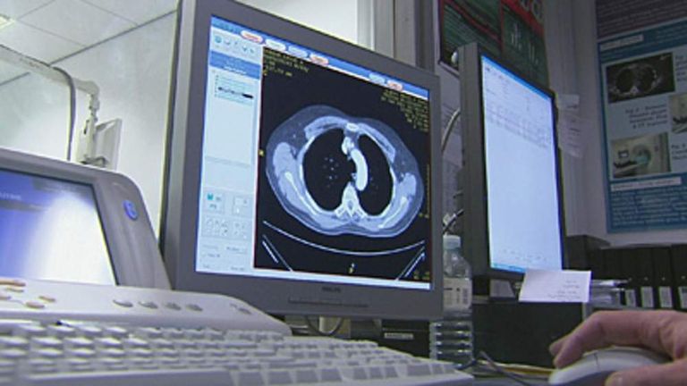 Trials May Help Cut UK Lung Cancer Deaths | UK News | Sky News