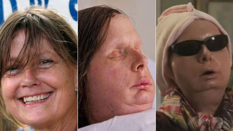 Charla Nash before her attack, after her transplant and giving her first interview since the operation