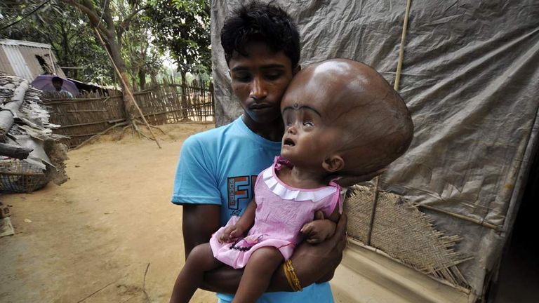 Help For Girl With Rare Giant Head Syndrome World News Sky News