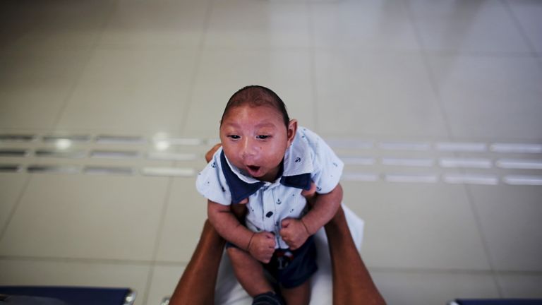 Zika has been linked with the birth defect microcephaly