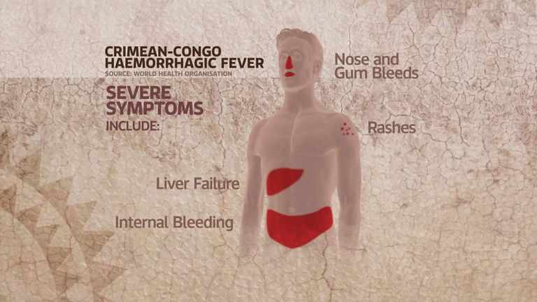 Crimean-Congo haemorrhagic fever symptoms