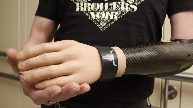 Three Austrian men have first thought-controlled bionic hands