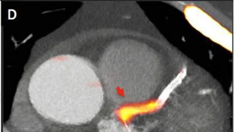 New Heart Scan 'Lights Up' Clot-Causing Fats | UK News | Sky News