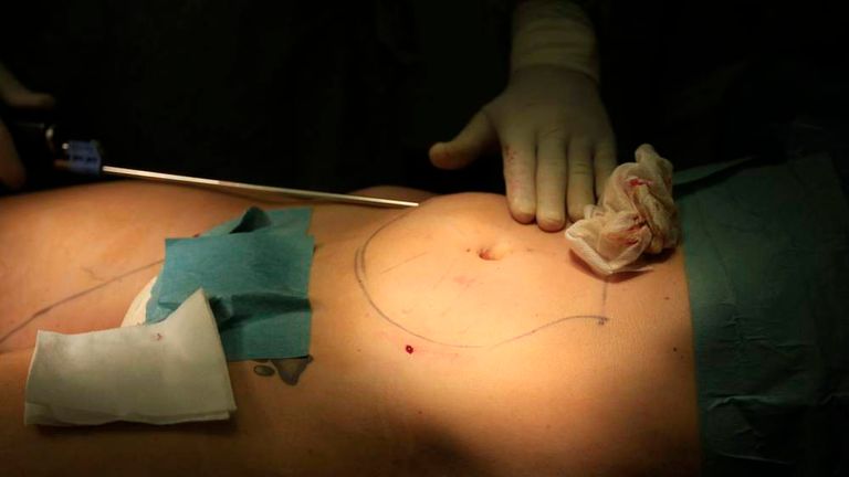 A Swedish woman living in Britain, undergoes a liposuction procedure at a plastic surgery clinic in Budapest