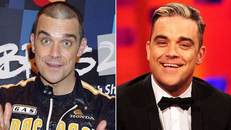 Robbie Williams Admits To Hair Transplant | Ents & Arts News | Sky News