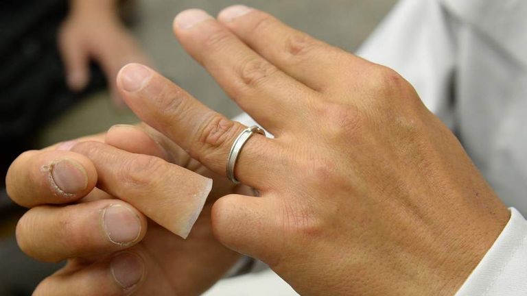 A former yakuza gangster shows off his silicone-made finger