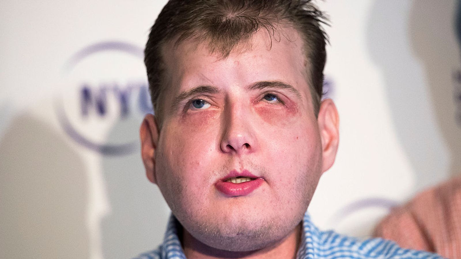 Firefighter Patrick Hardison Feels 'Normal' A Year After Face Transplant