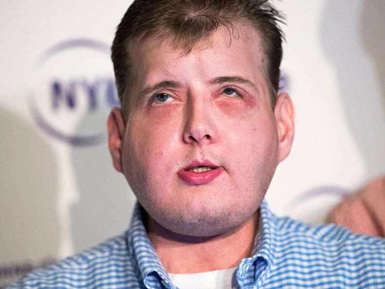 Firefighter Patrick Hardison Feels 'Normal' A Year After Face Transplant