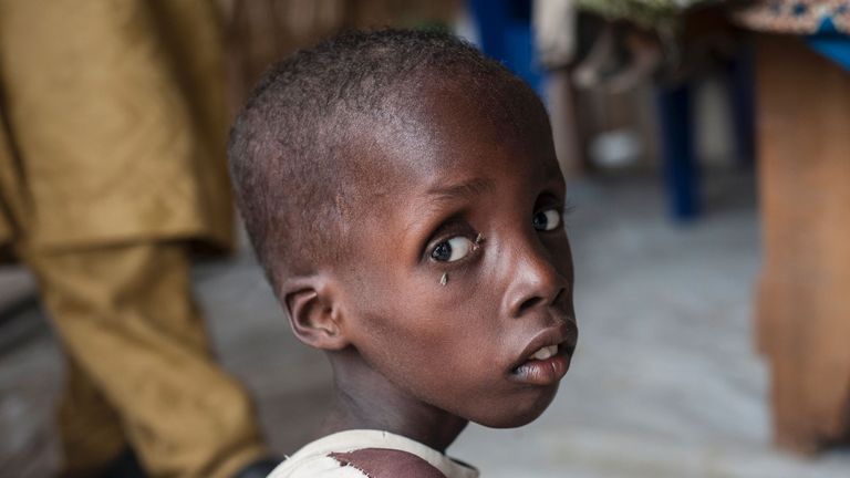 A malnourished boy at a settlement on the outskirts of Maiduguri, capital of Borno state