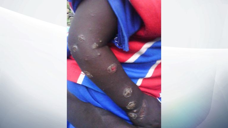 A child with blisters on his arm said by Amnesty International to have been caused by chemical weapons in Darfur, Sudan