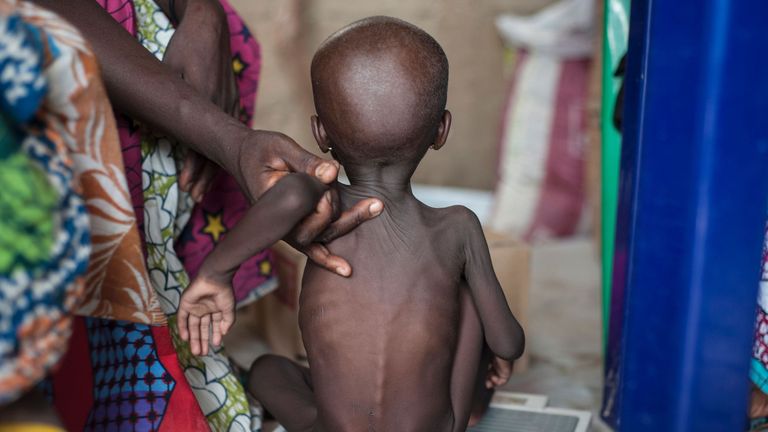 A malnourished child at the Muna settlement, which houses nearly 16,000 refugees on the outskirts of Maiduguri