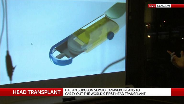 The knife to be used by Prof Sergio Canavero in what he hopes will be the first human head transplant