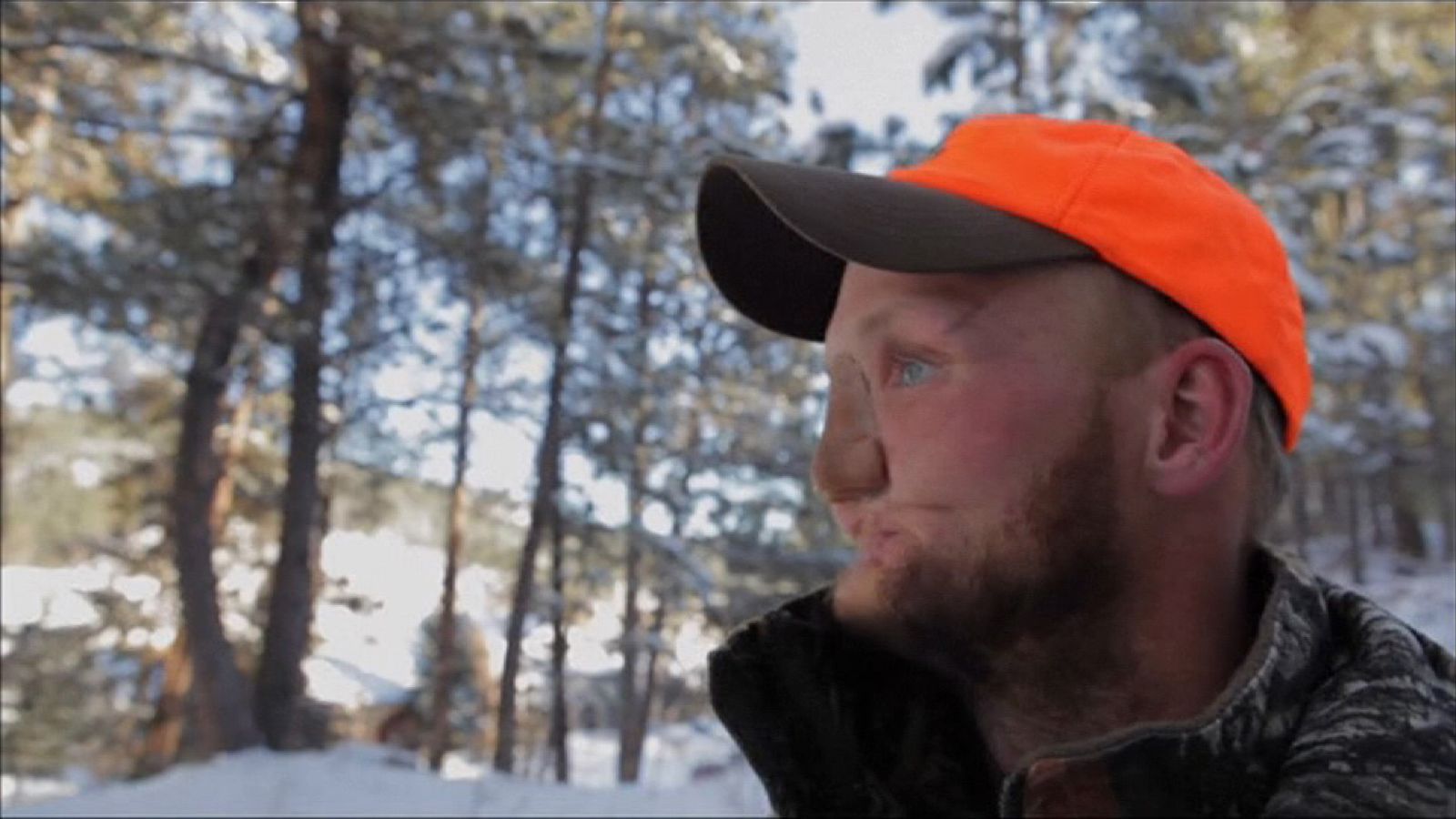 Face transplant surgery exceeds patient Andy Sandness' expectations ...