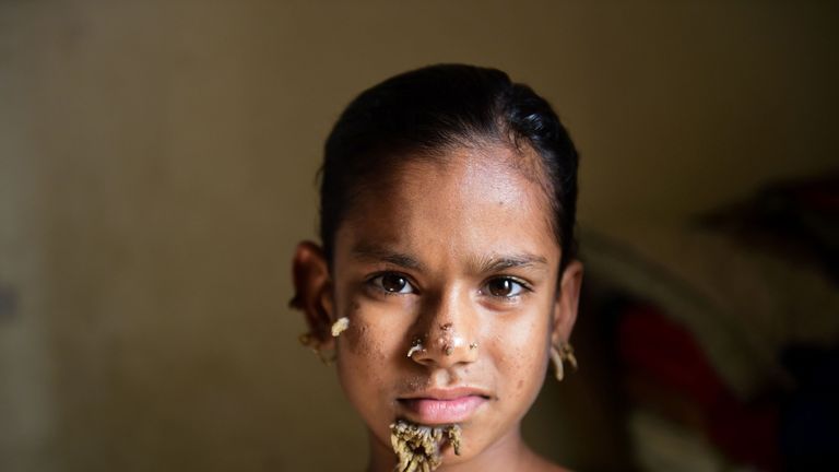 10-year-old Bangladeshi girl Sahana Khatun, could be the first female ever afflicted by so-called &#39;tree man syndrome&#39;