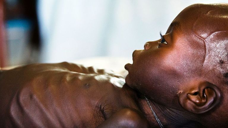 A young South Sudanese boy with acute malnutrition
