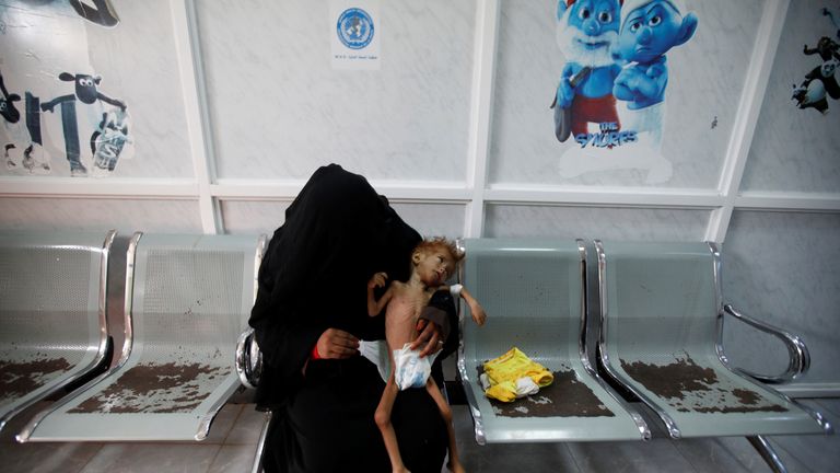 A woman holds her malnourished child at a clinic in the city of Houdeidah