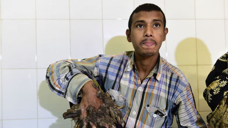 So-called &#39;Tree Man&#39; Abul Bajandar, from Bangladesh, with his daughter , after surgery to remove massive warts on his body