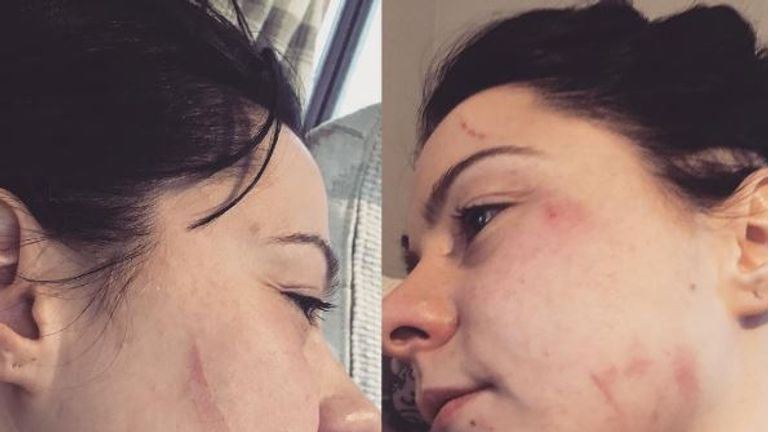 A spokesman for Spraggan said she suffered cuts and bruises to the face and bite lacerations