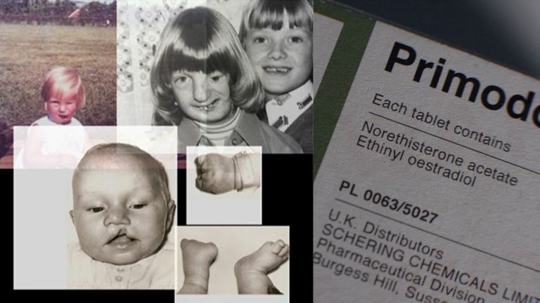 A public inquiry in investigating allegations of birth defects as a result of the drug Primodos