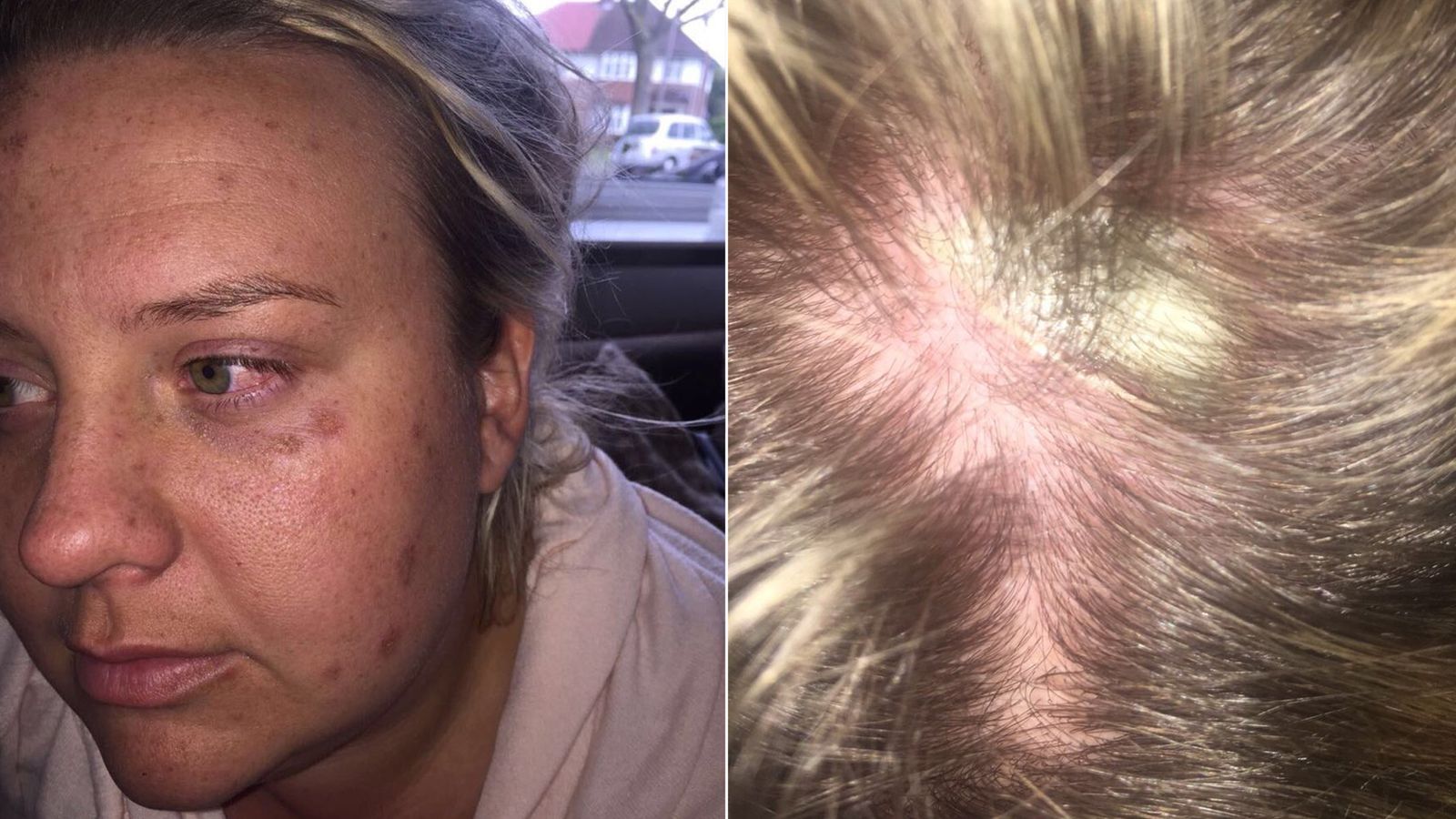 Victim Reveals Acid Injuries After Attack At London Bar Mangle E8 