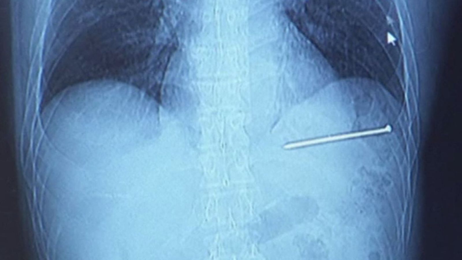 Man 'lucky to survive' after shooting himself in heart with nail gun