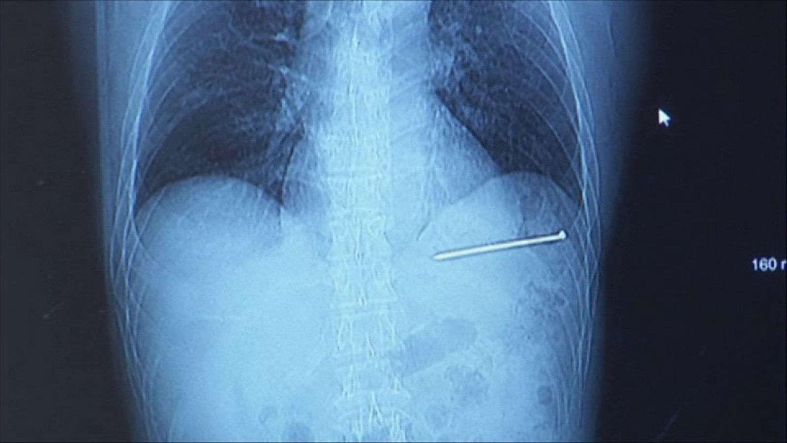 Doug Bergeson's X-ray shows how close a nail came to his heart