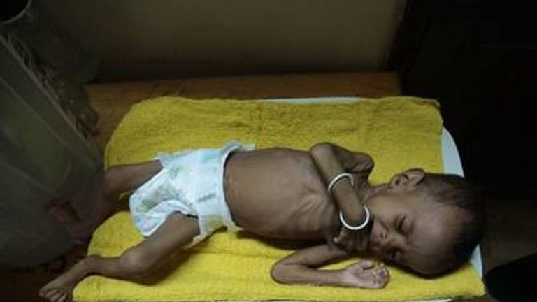 10-month-old Arwa is suffering from severe malnutrition. Pic: Save the Children 