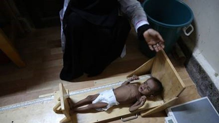 Millions of children are at greater risk from cholera due to malnutrition 