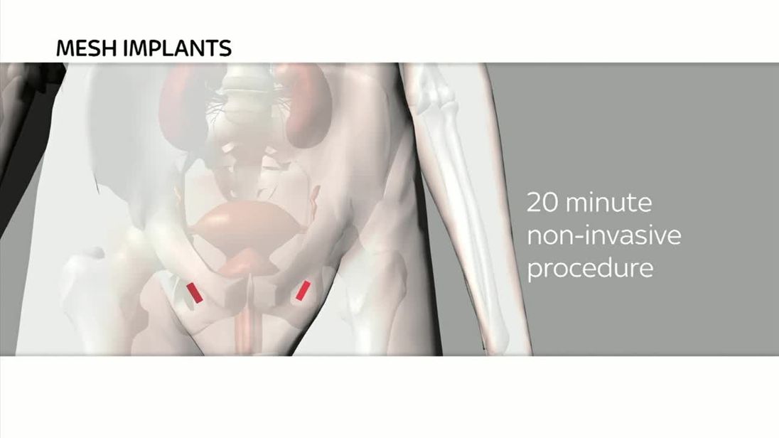 How does vaginal mesh work?