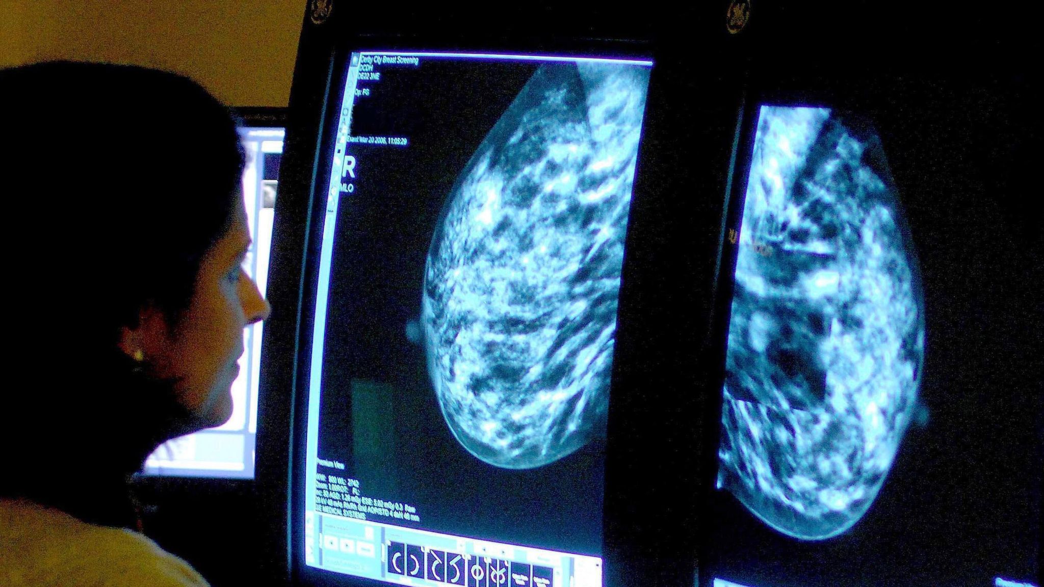 Breast cancer can lay dormant for 15 years, researchers find UK News