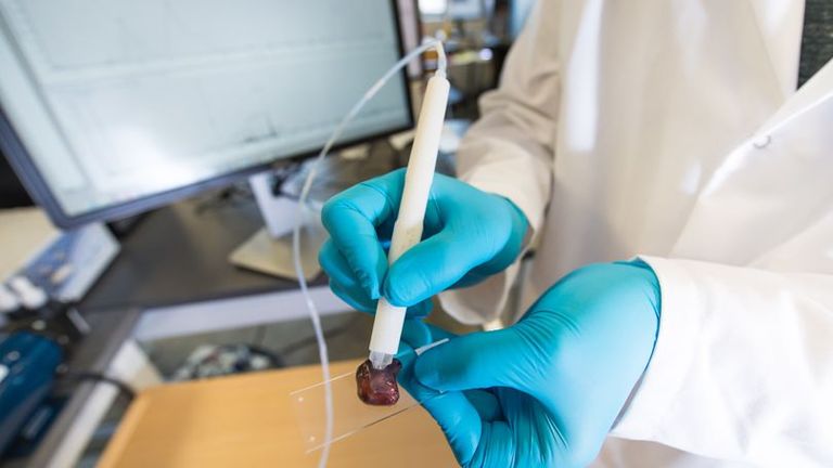 The MasSpec Pen can identify cancerous tissue in 10 seconds Pic: University of Texas