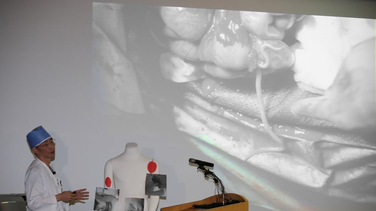 A surgeon Lee Cook-jong gives a briefing during a news conference at a hospital in Suwon, South Korea, November 15, 2017