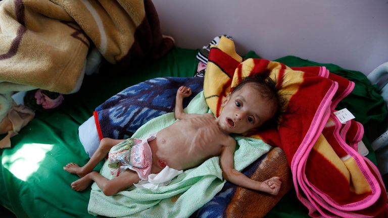 A malnourished Yemeni child receives treatment at a hospital in the capital Sanaa