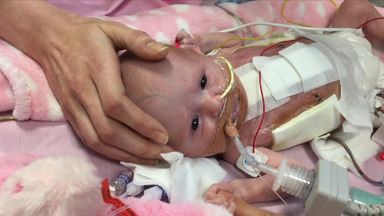 Vanellope: Baby survives after being born with heart outside body | UK ...