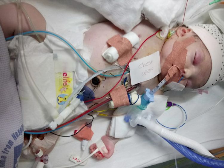 Amelia has had two major open heart surgeries in the 10 months she has been alive