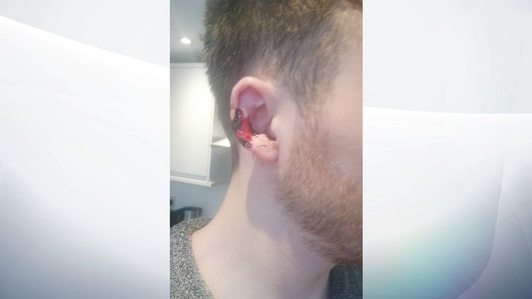 The 24-year-old victim was bitten during the row